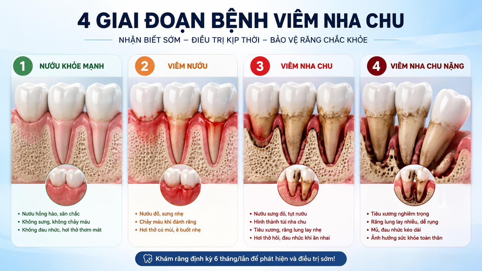 4 giai đoạn từ viêm nướu đến viêm nha chu gây tiêu xương rụng răng