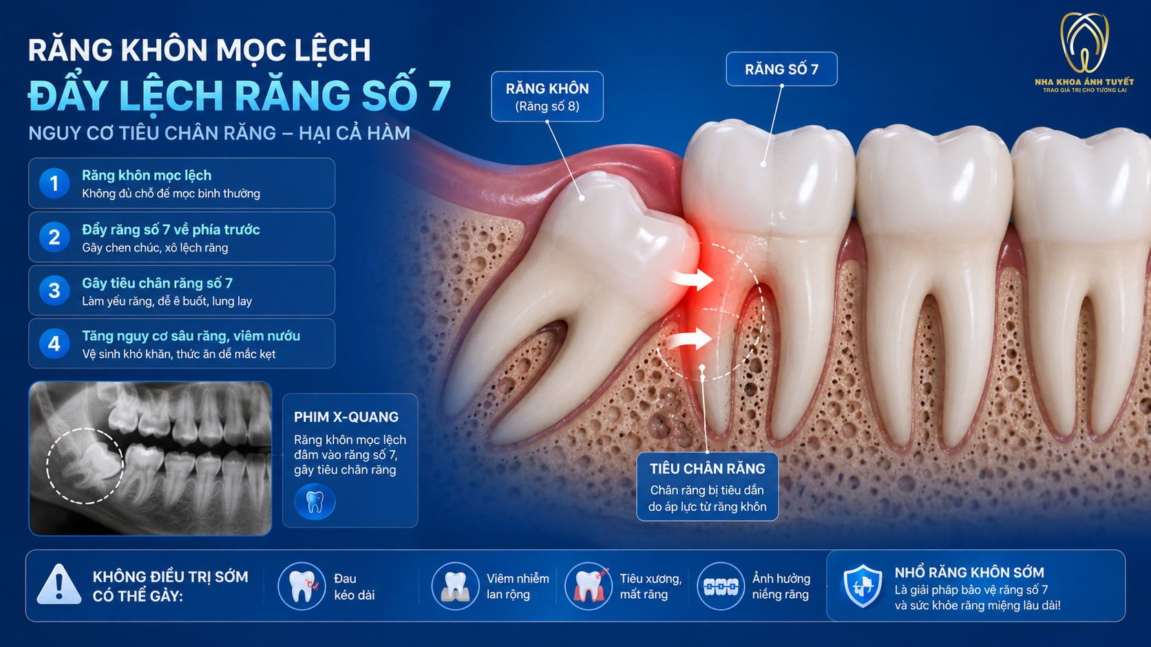 Hình ảnh 3D mô phỏng răng khôn mọc lệch đâm hỏng răng số 7