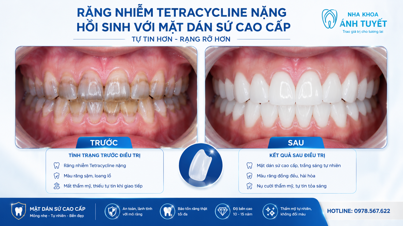 Trường hợp răng nhiễm màu nặng cần chuyển hướng dán sứ Veneer thay vì tẩy trắng răng