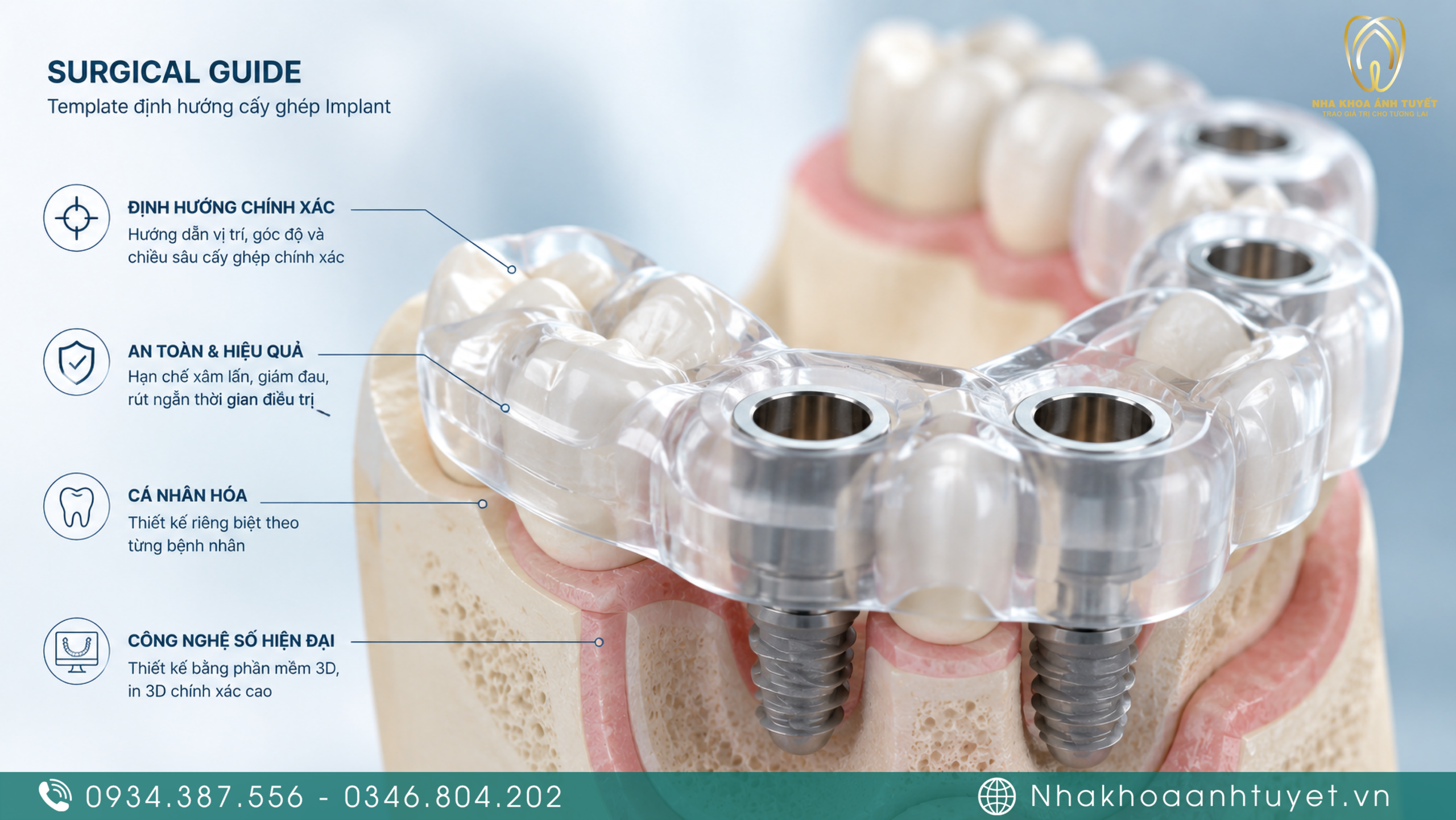 Máng hướng dẫn phẫu thuật định vị chính xác vị trí đặt trụ
