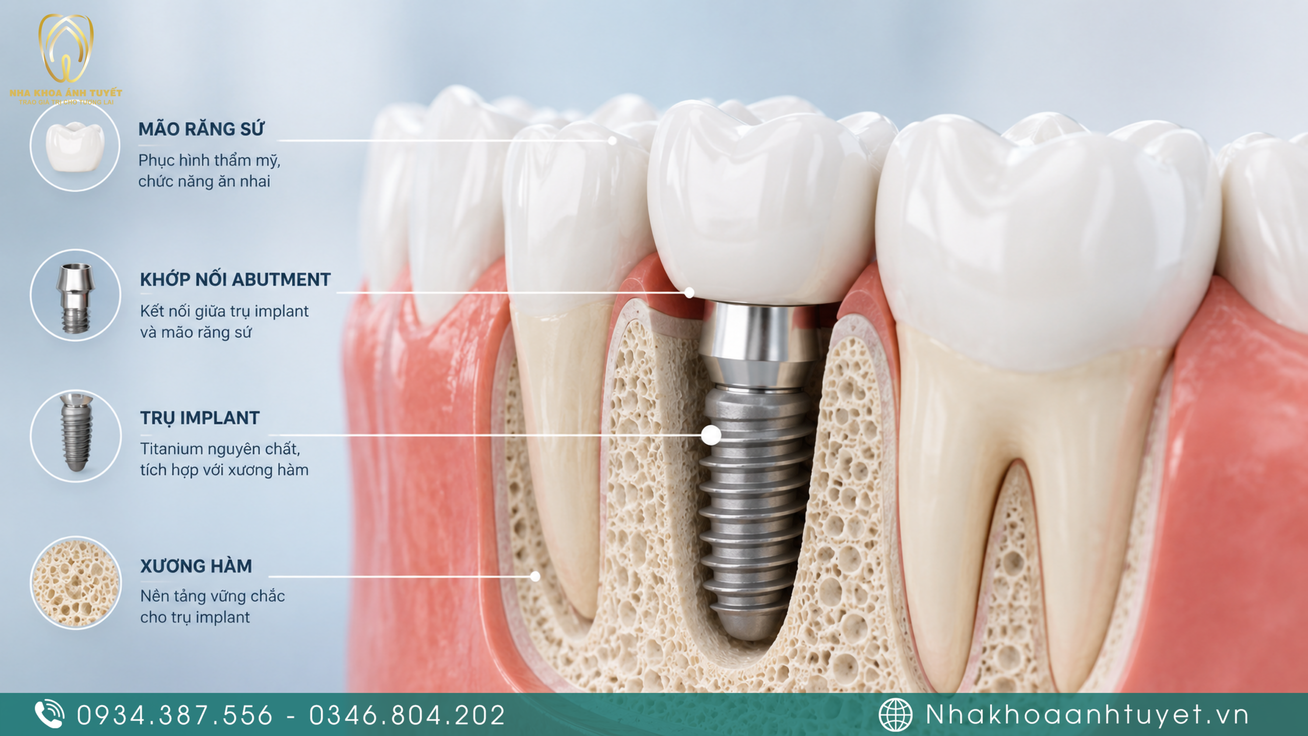 Mô hình 3D vị trí trụ implant tích hợp hoàn hảo trong xương hàm