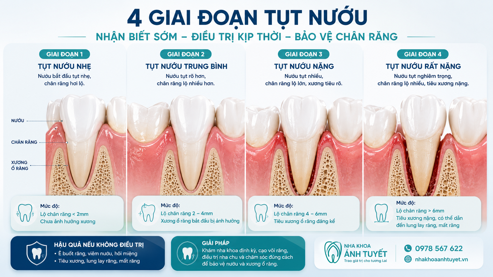 Hình ảnh minh họa các mức độ tụt nướu răng từ nhẹ đến nặng
