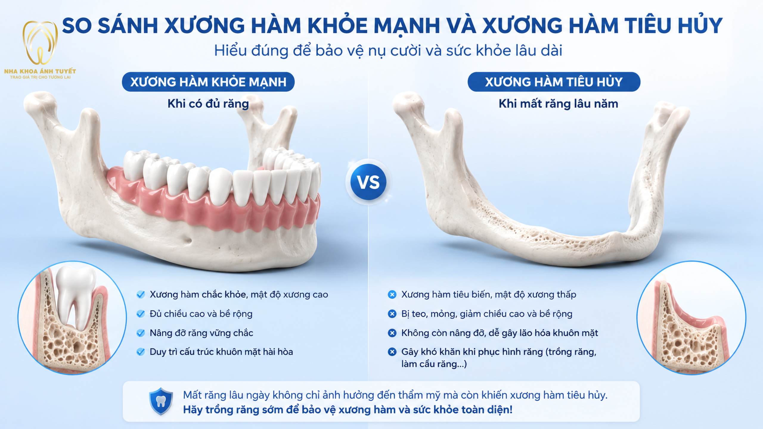 so sánh hàm bị tiêu xương và hàm khỏe mạnh
