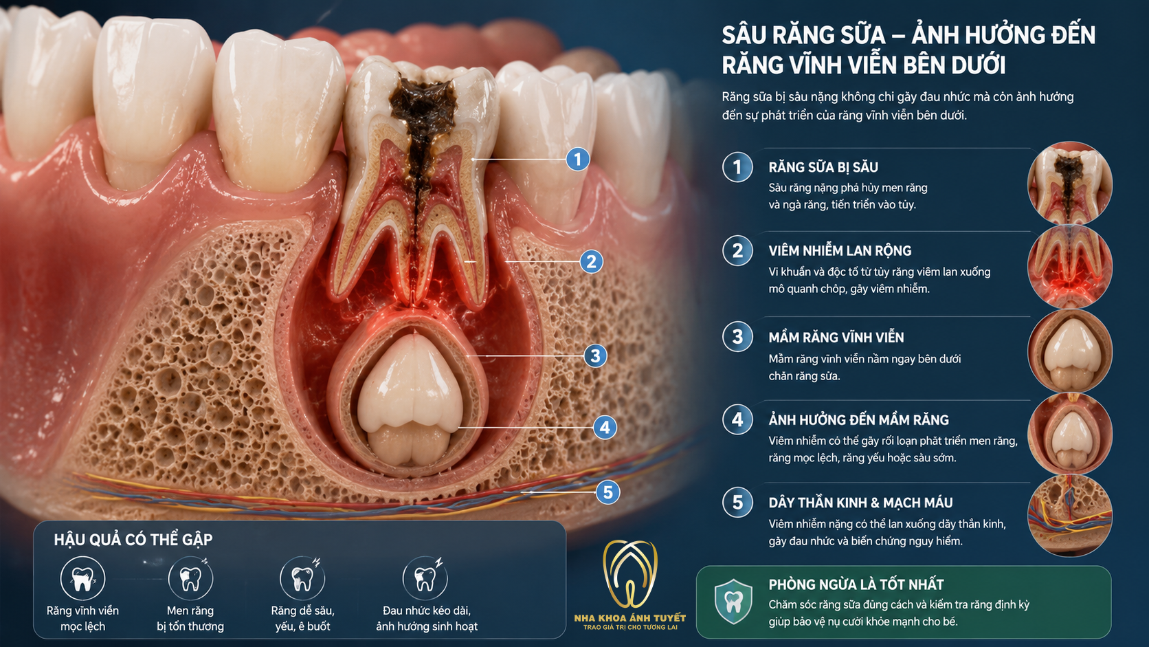 Sơ đồ y khoa thể hiện mầm răng vĩnh viễn bị tổn thương do ổ viêm nhiễm