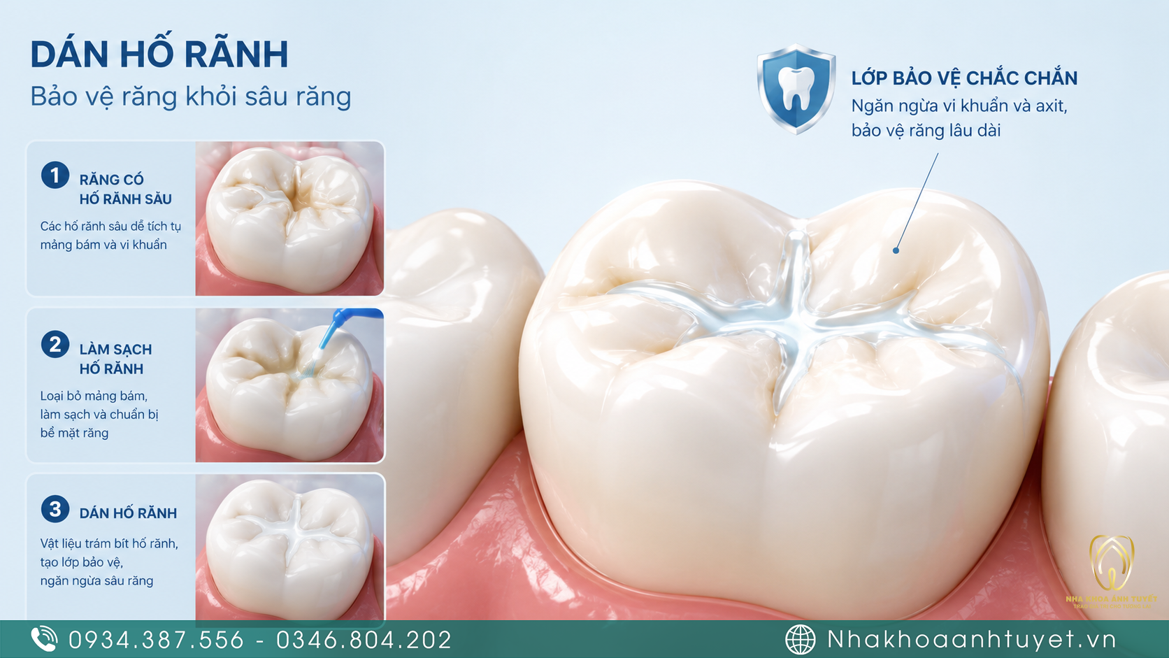 Sơ đồ 3D mô phỏng các hố rãnh sâu hẹp trên mặt nhai răng hàm