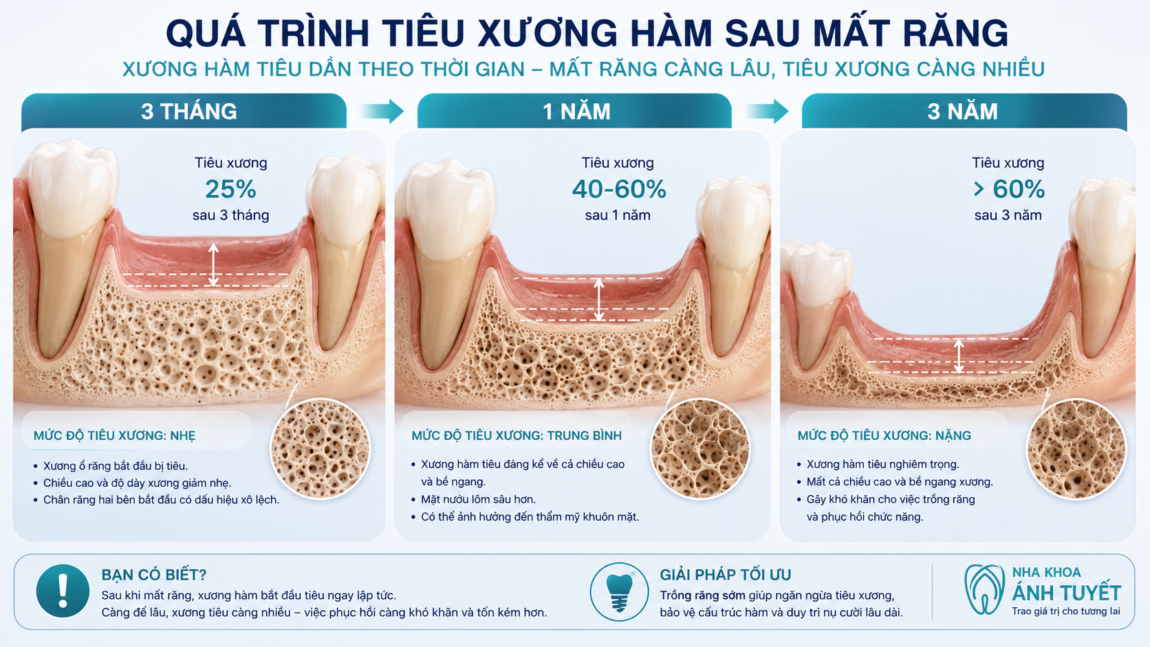 Diễn tiến biến chứng mất răng tiêu xương hàm theo từng mốc thời gian