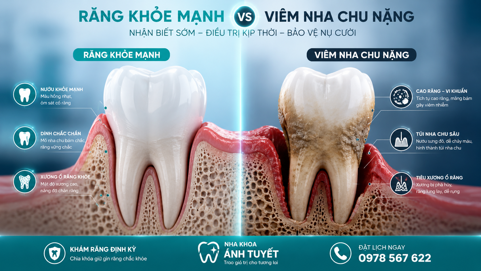 Bệnh viêm nha chu là nguyên nhân hàng đầu gây mất răng ở người trưởng thành
