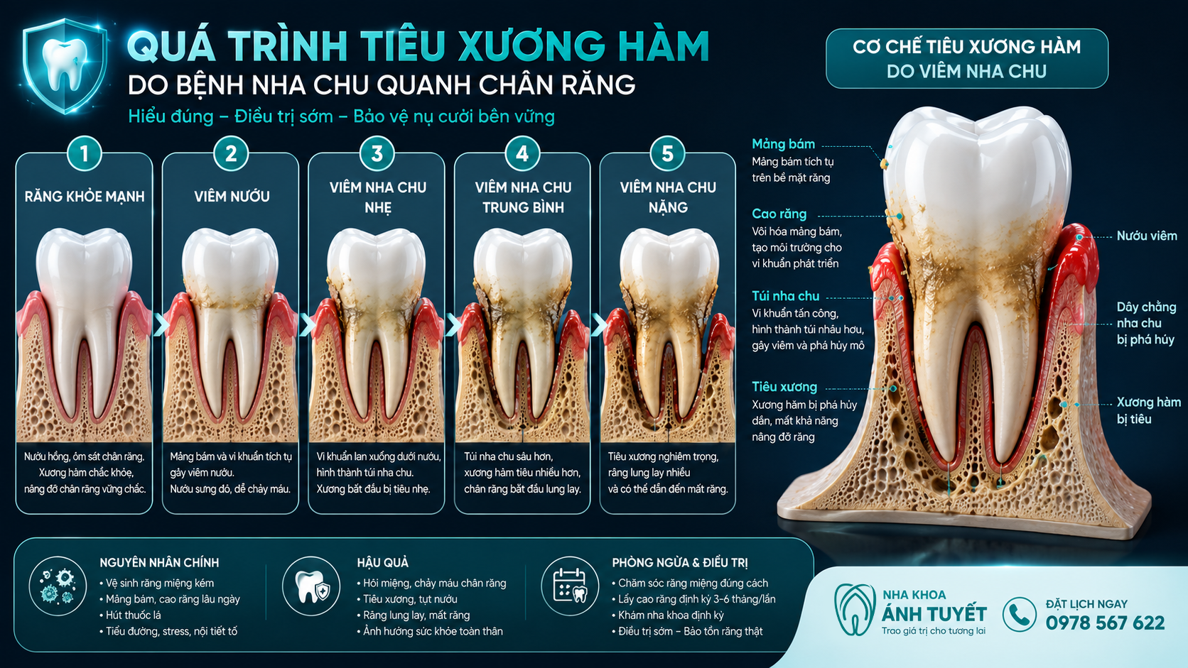Quá trình tiêu xương ổ răng không thể hồi phục do bệnh viêm nha chu gây ra