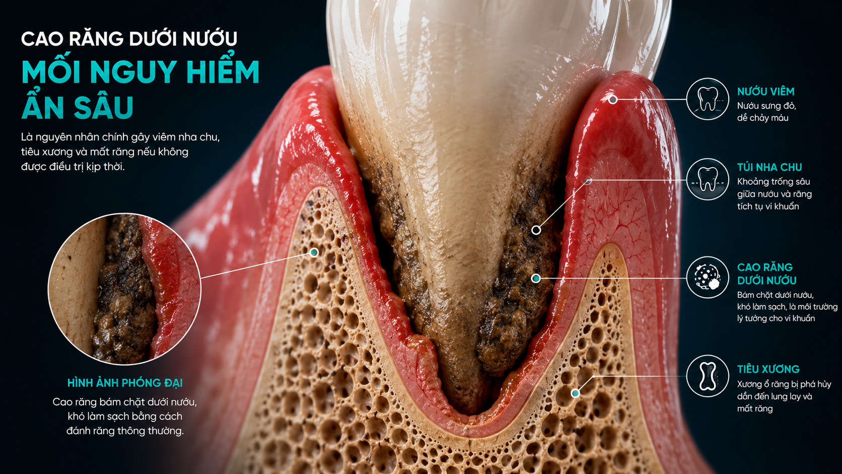 Vôi răng dưới nướu âm thầm tàn phá mô nha chu và xương hàm