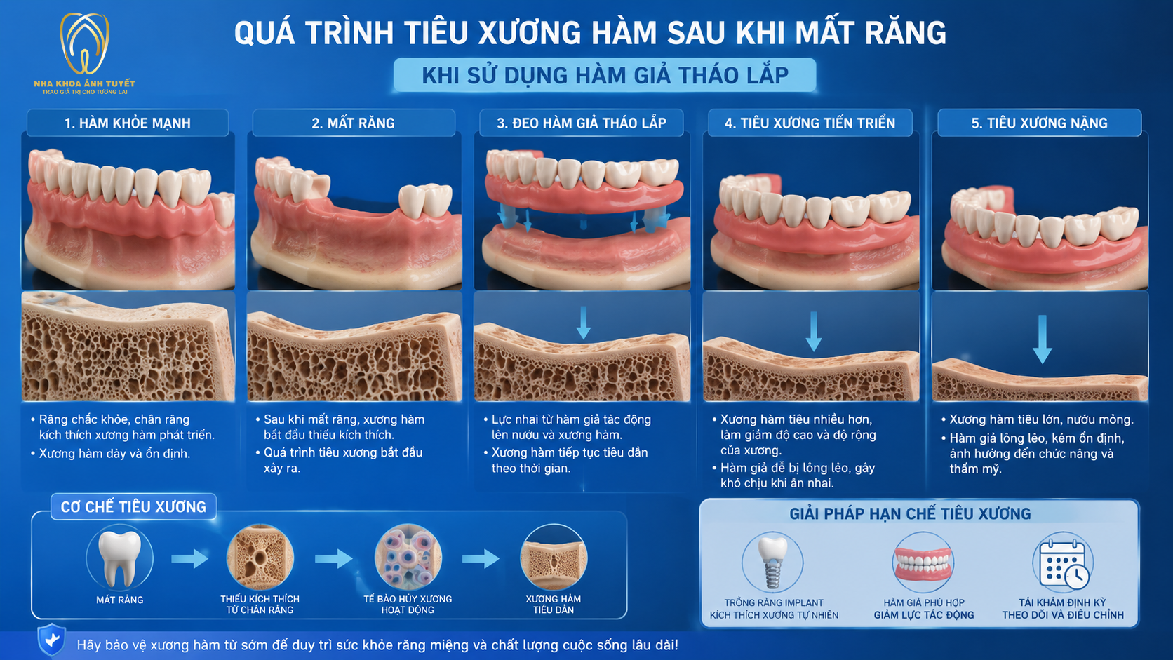 Mô phỏng 3D hiện tượng tiêu xương hàm ở người già làm hàm giả xô lệch