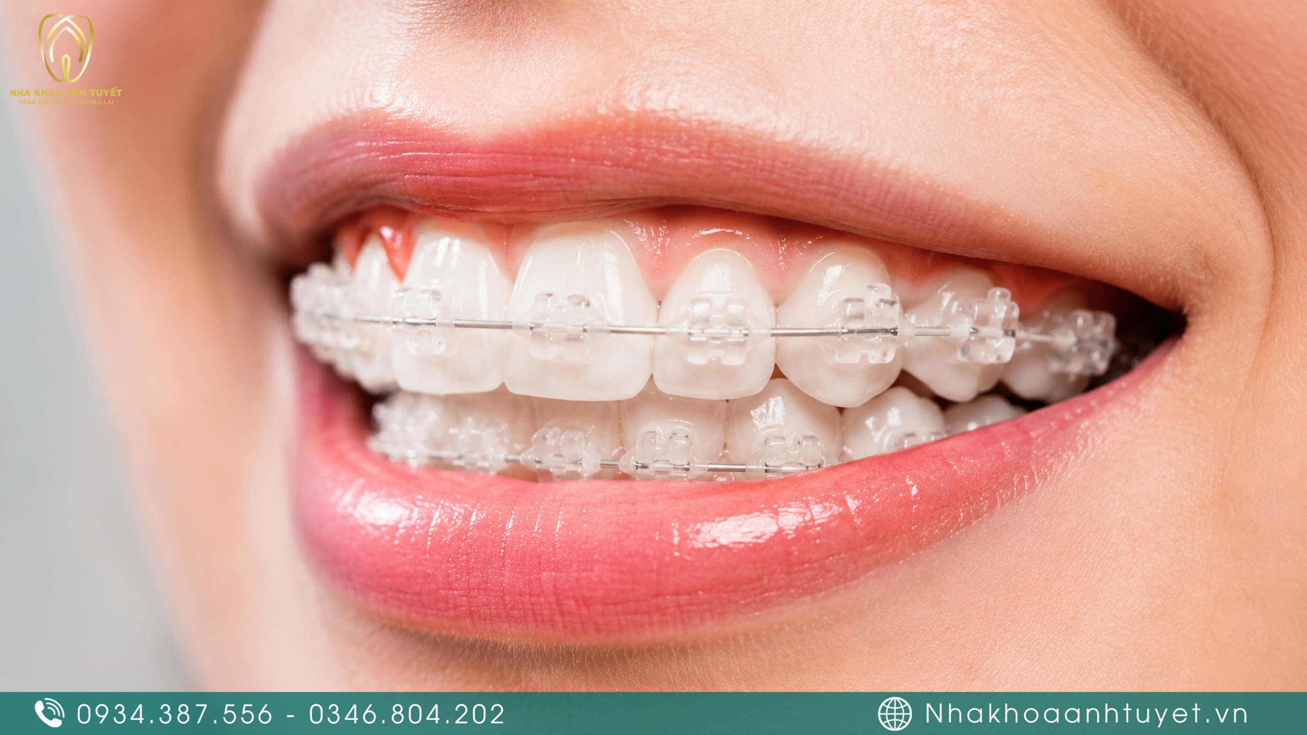 Vật liệu sứ có màu sắc tương đồng với màu men răng thật