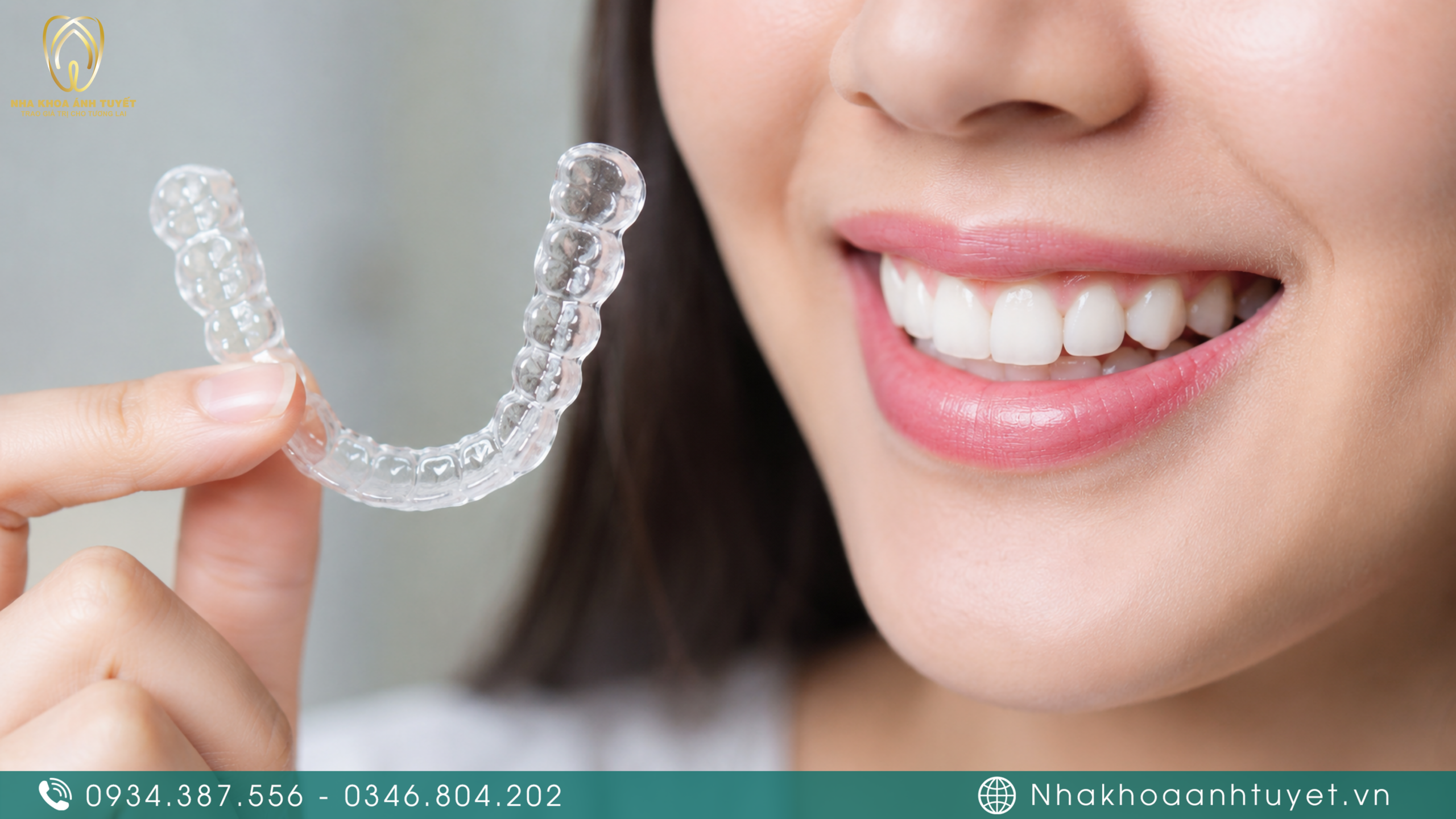 máng chỉnh nha suốt tháo lắp tiện lợi và thẩm mỹ