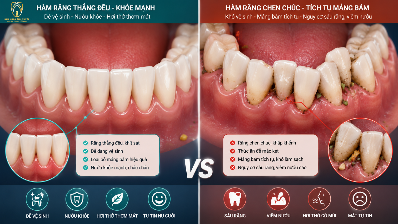 Răng khấp khểnh tạo ra các kẽ hở khó vệ sinh dẫn đến sâu răng và nha chu