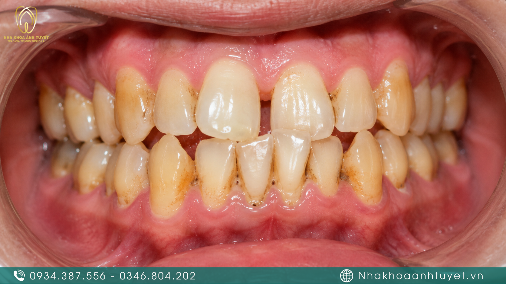 Tình trạng răng khấp khểnh chen chúc gây ảnh hưởng thẩm mỹ và sức khỏe