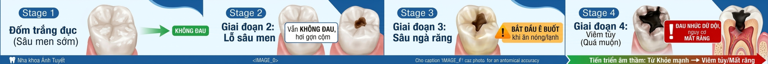"Điều trị sâu răng không đau tại Nha khoa Ánh Tuyết".