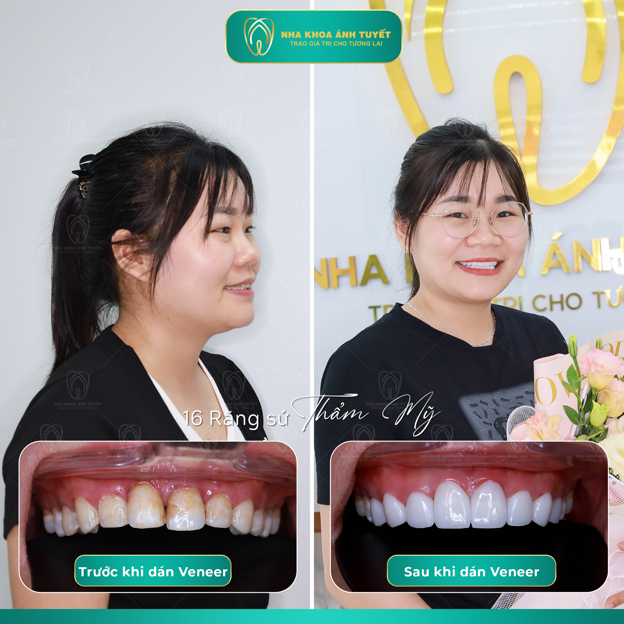 Thiết Kế Răng Sứ Veneer Thẩm Mỹ