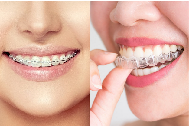 Ưu điểm của niềng răng trong suốt Invisalign