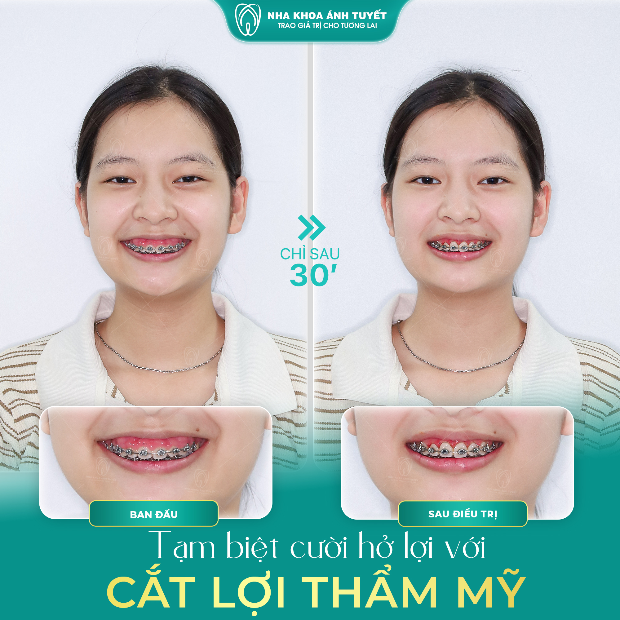 Điều Trị Cười Hở Lợi Cho Khách Hàng