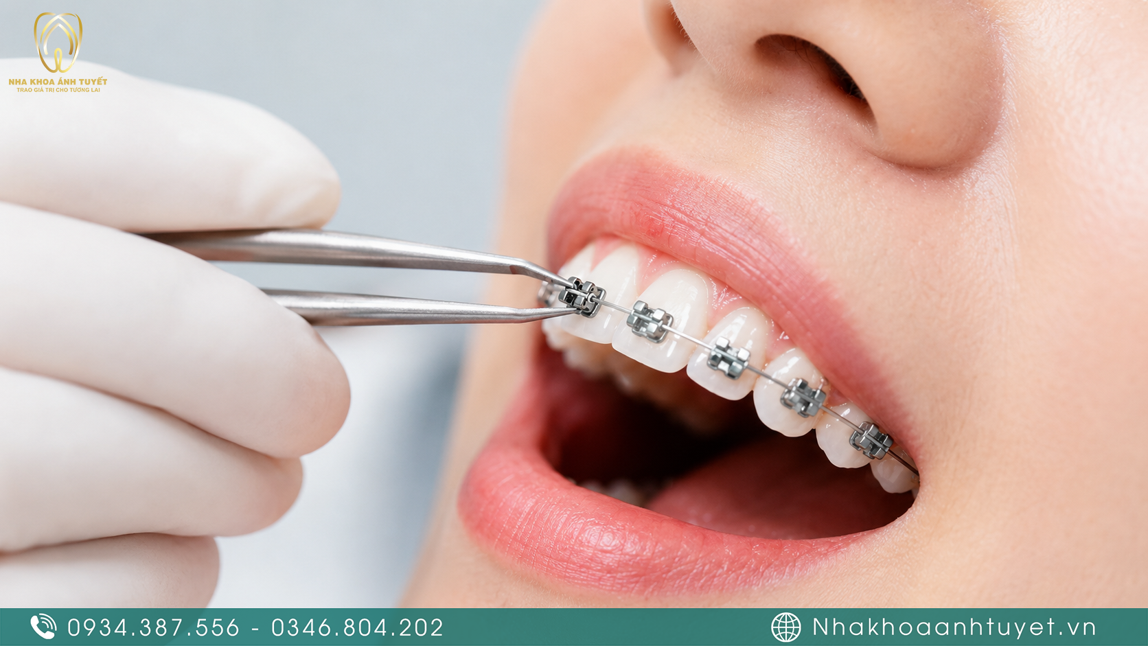 Thao tác gắn mắc cài chuẩn xác và nhẹ nhàng trong quy trình niềng răng