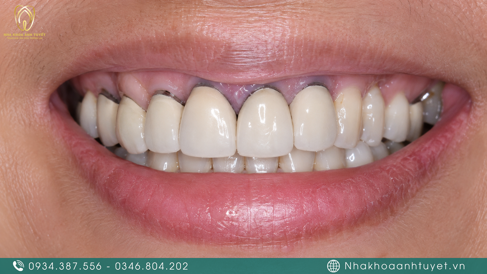 Viền nướu bị xẫm màu đen do răng sứ kim loại cũ oxy hóa