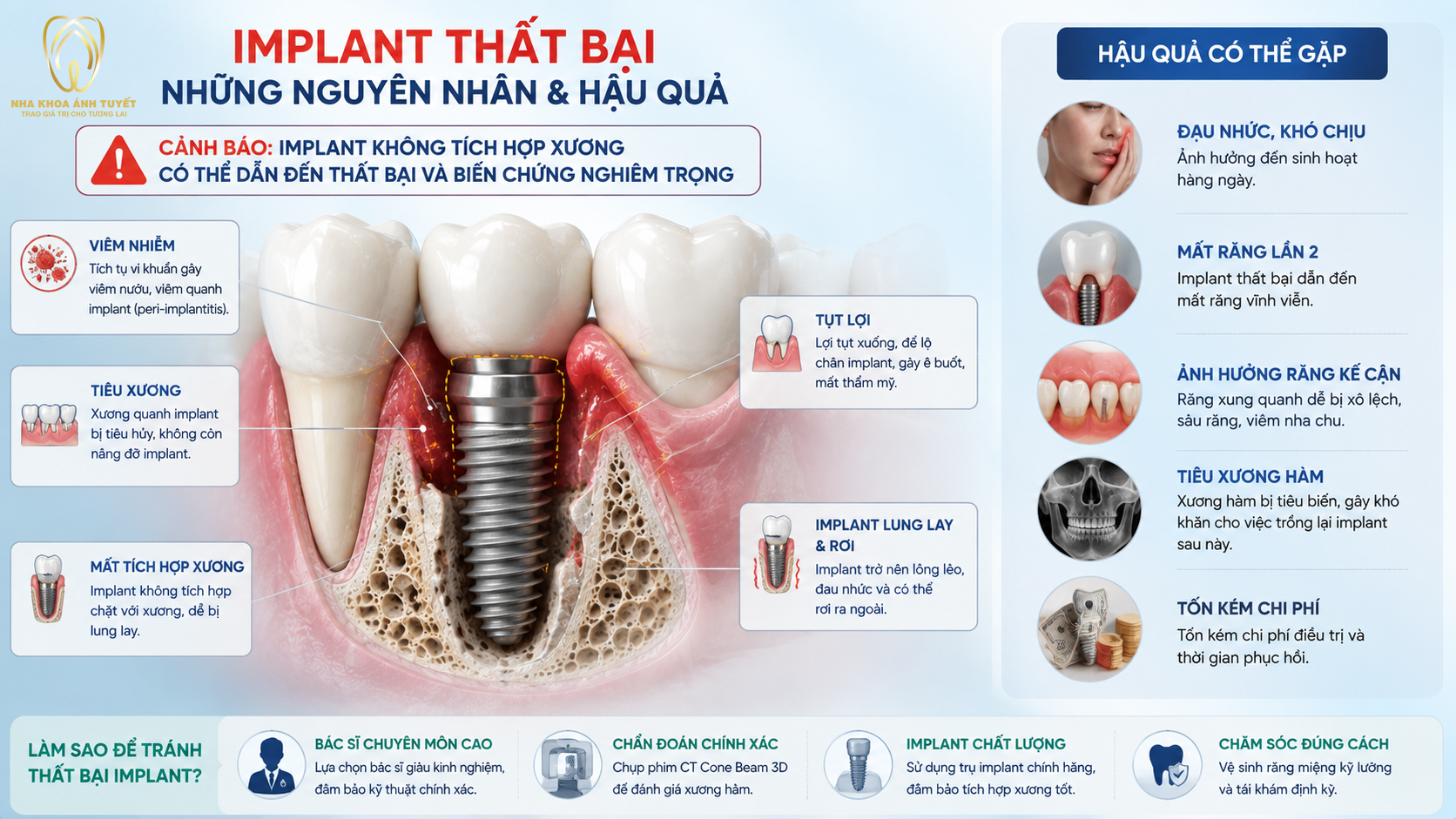Cảnh báo rủi ro biến chứng đào thải khi trồng răng ngay sau khi nhổ sai chỉ định