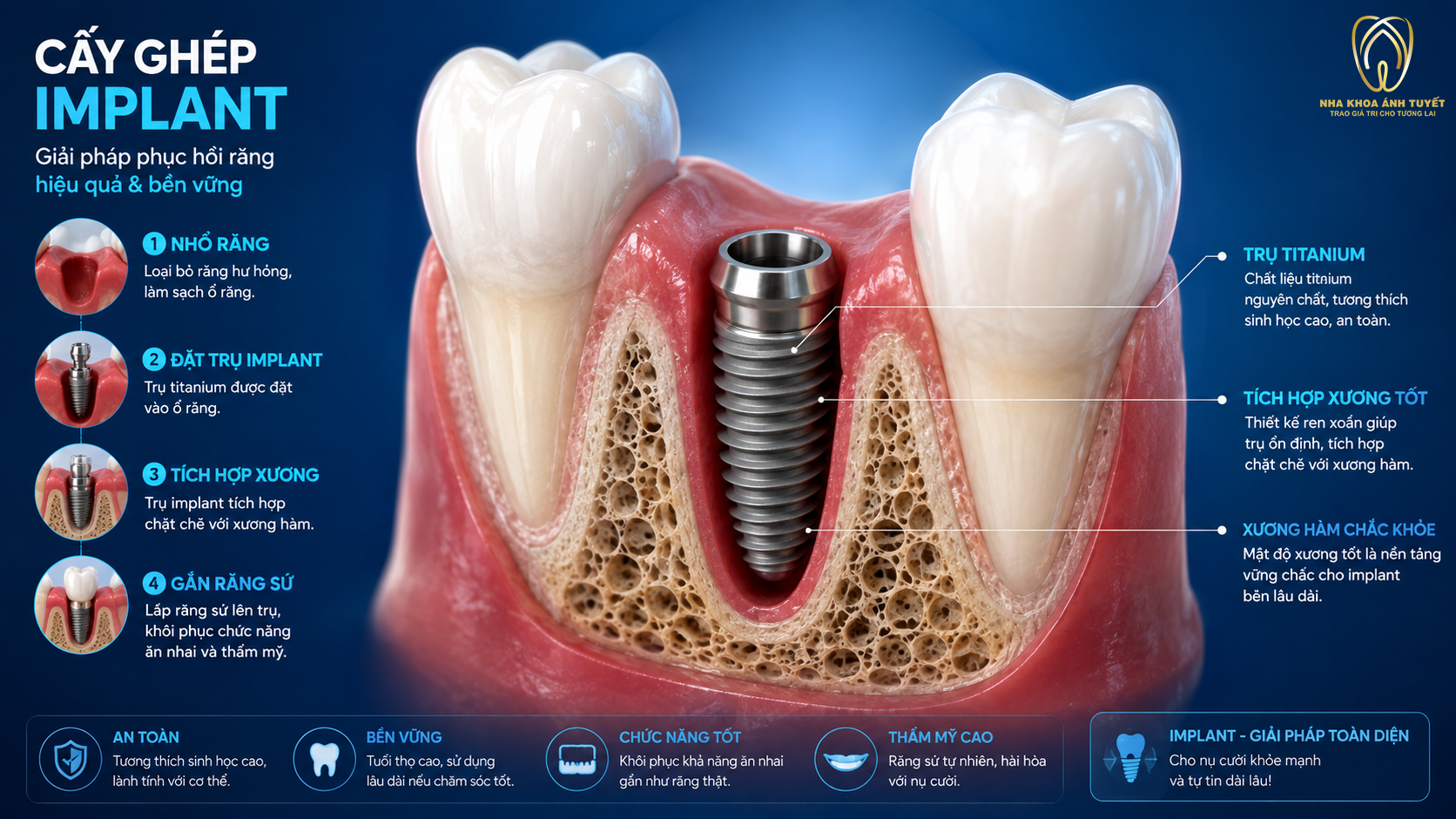 Mô phỏng 3D điều kiện mật độ xương ổ răng đạt chuẩn để cấy ghép tức thì