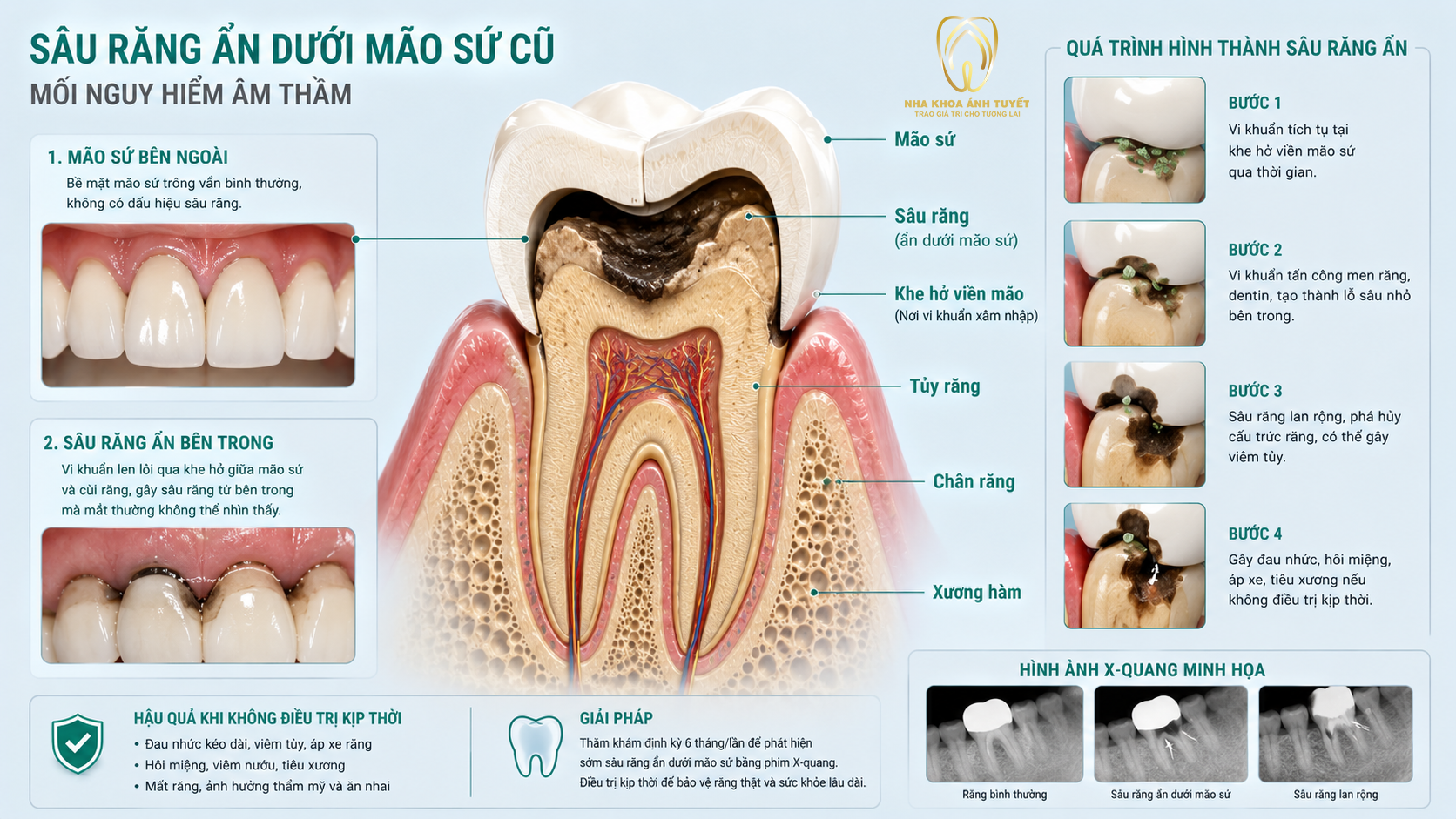 Tình trạng cùi răng bên trong bị vi khuẩn tấn công gây sâu mục
