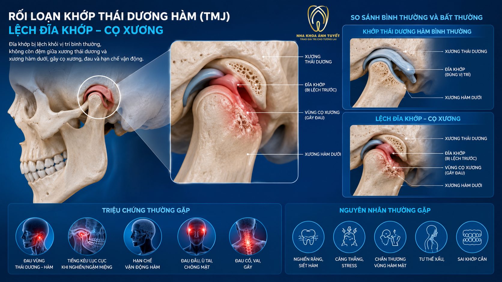 Mô phỏng đĩa khớp bị lệch gây hiện tượng phát ra tiếng kêu ở hàm