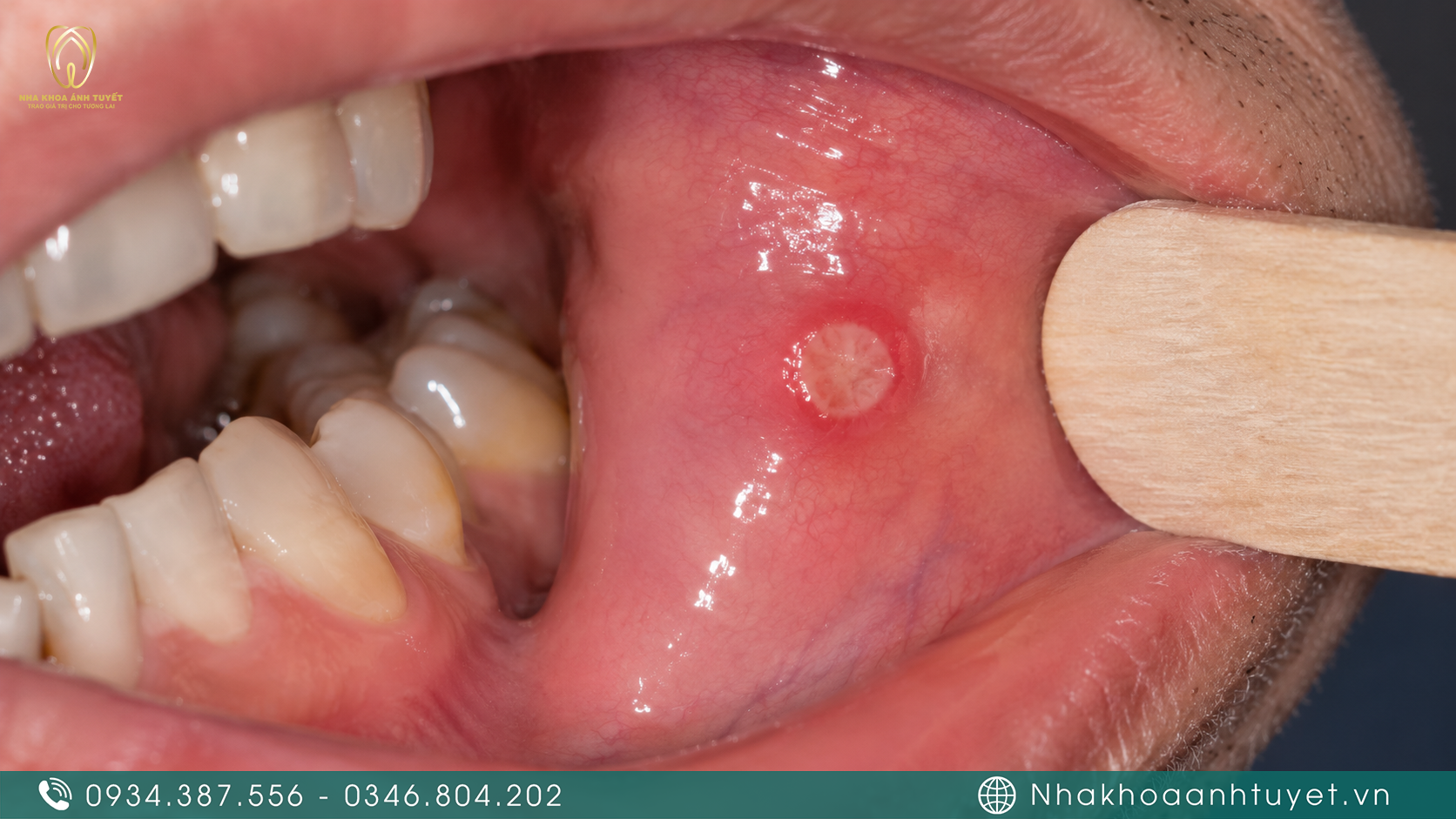 Vết loét miệng kéo dài gây đau rát khó chịu khi ăn uống