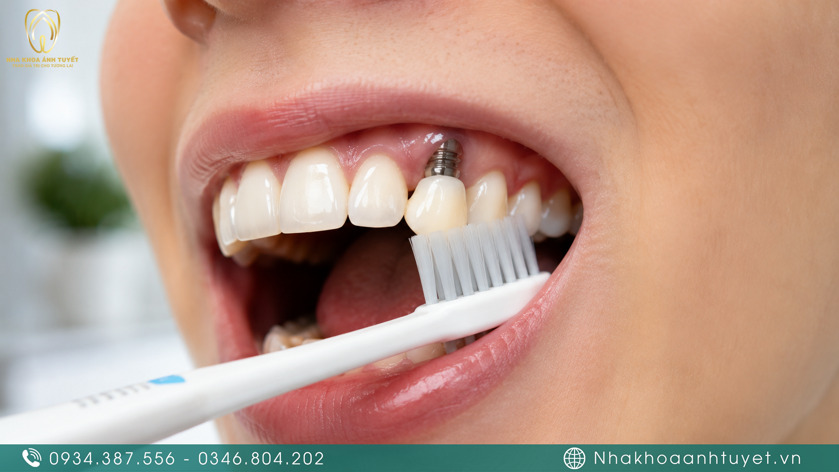 Hướng dẫn các bước vệ sinh khoang miệng sau khi cấy ghép trụ răng