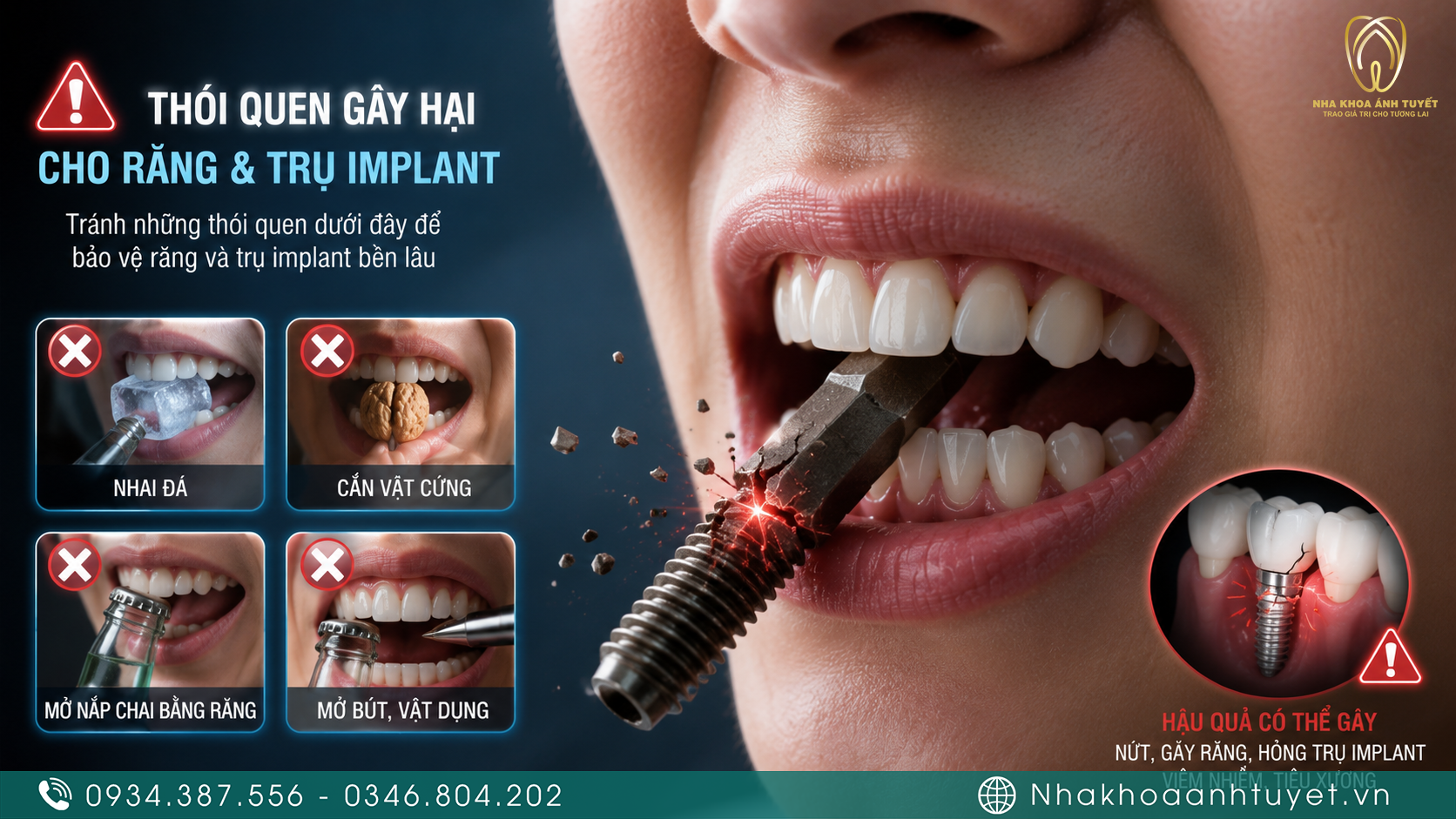 Cảnh báo các tác nhân gây nguy cơ ảnh hưởng đến độ bền của trụ răng