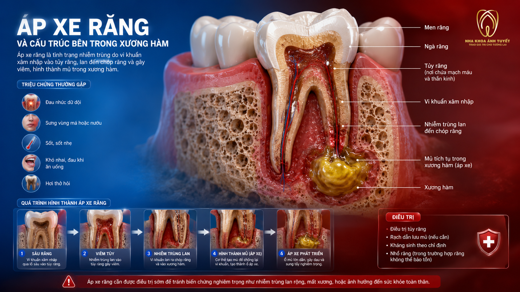 Mô phỏng 3D sự phát triển của vi khuẩn áp xe trong xương hàm