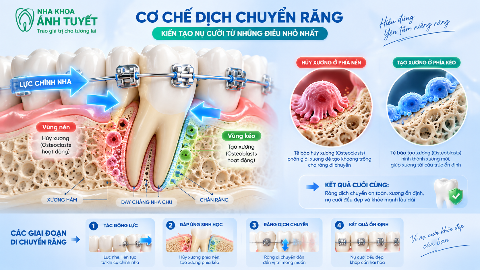 Mô phỏng 3D sự di chuyển của chân răng dưới tác động của lực kéo khí cụ