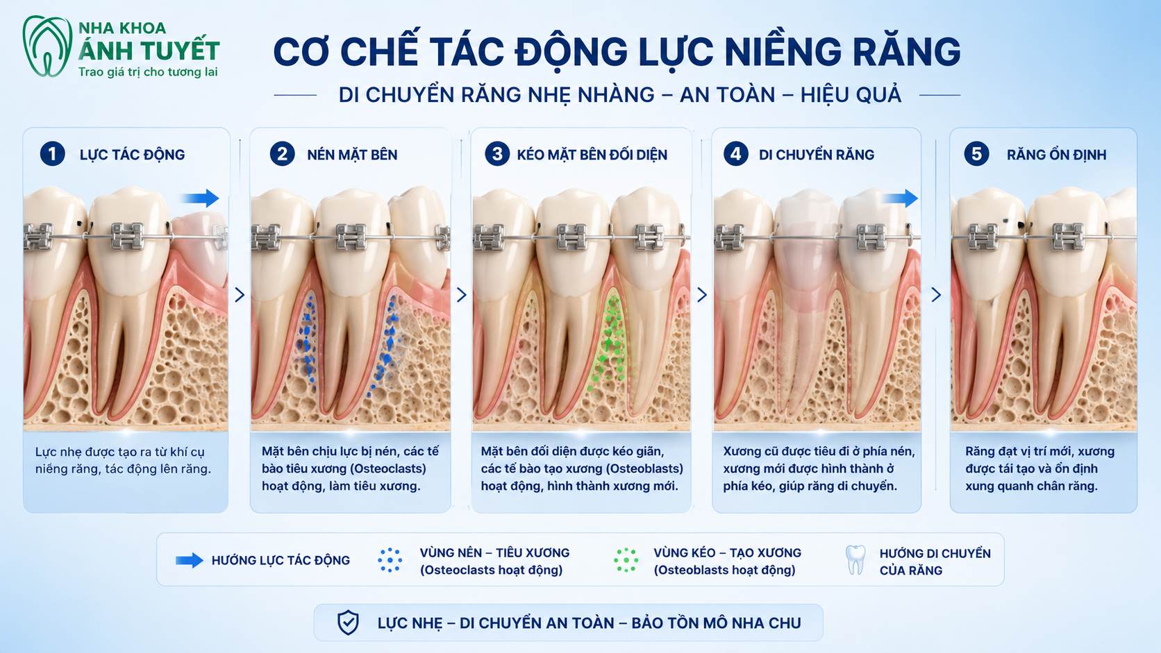 Mô phỏng 3D sự di chuyển của chân răng dưới tác động của lực kéo khí cụ