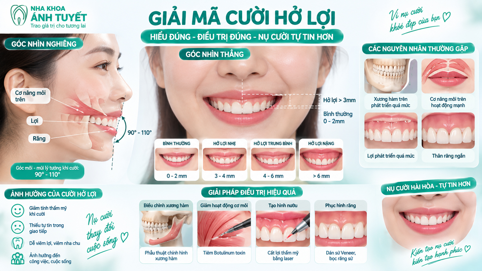 Hình ảnh minh họa các nguyên nhân chính gây ra tình trạng cười hở lợi