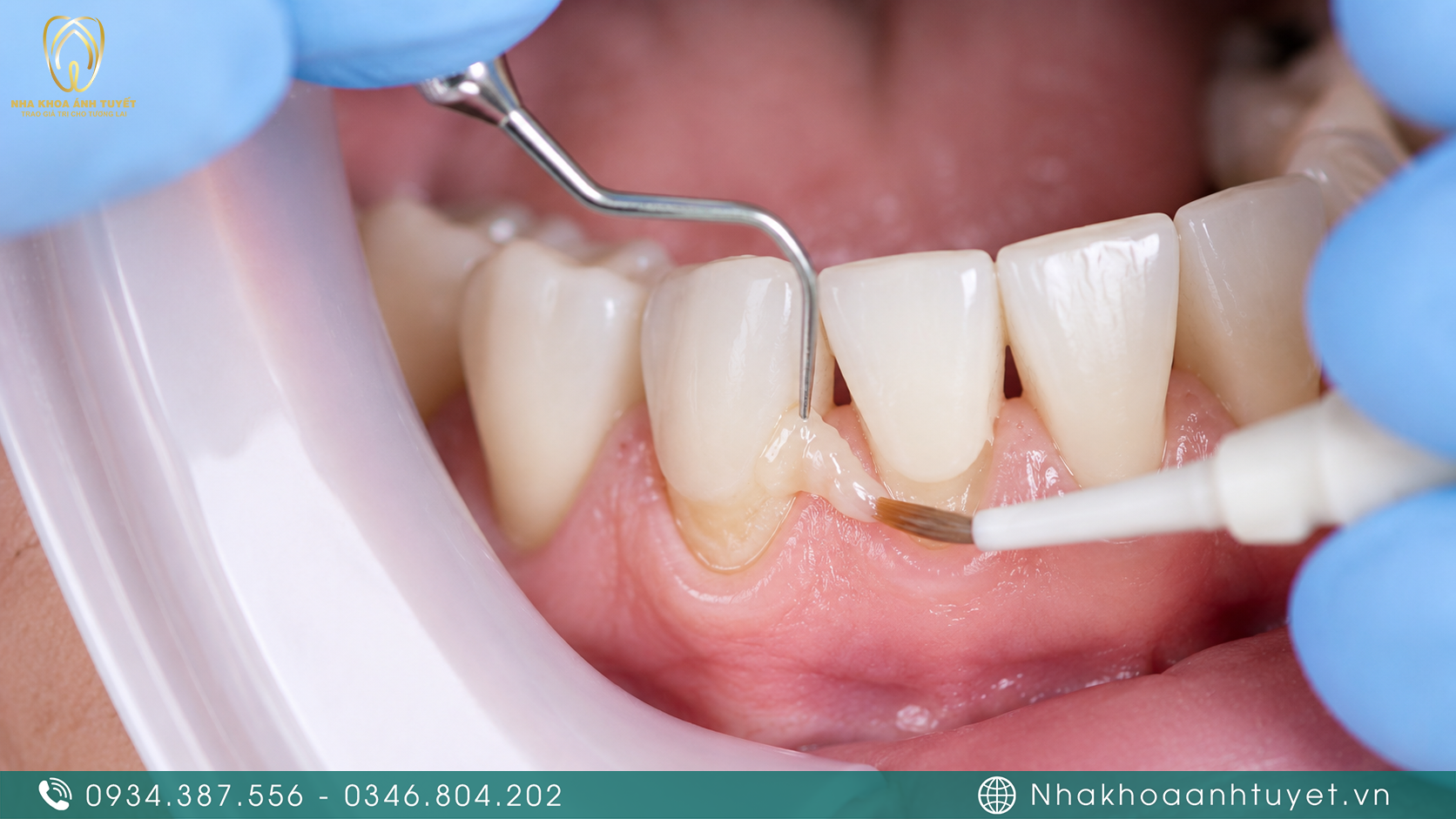 Kỹ thuật trám cổ răng thẩm mỹ phục hồi mô răng bị mòn