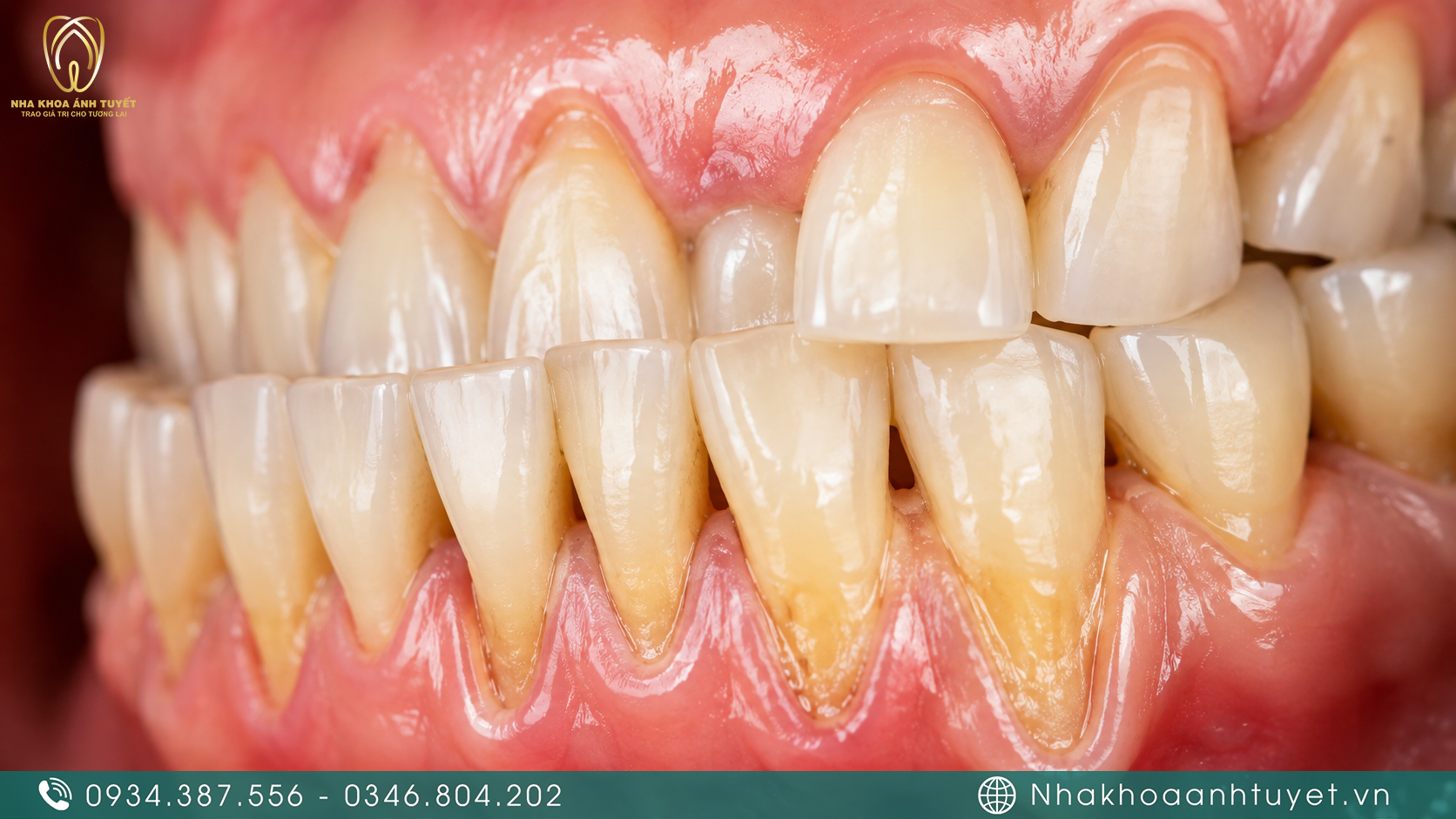 Tình trạng mô nướu bị co rút làm lộ chân răng gây ê buốt