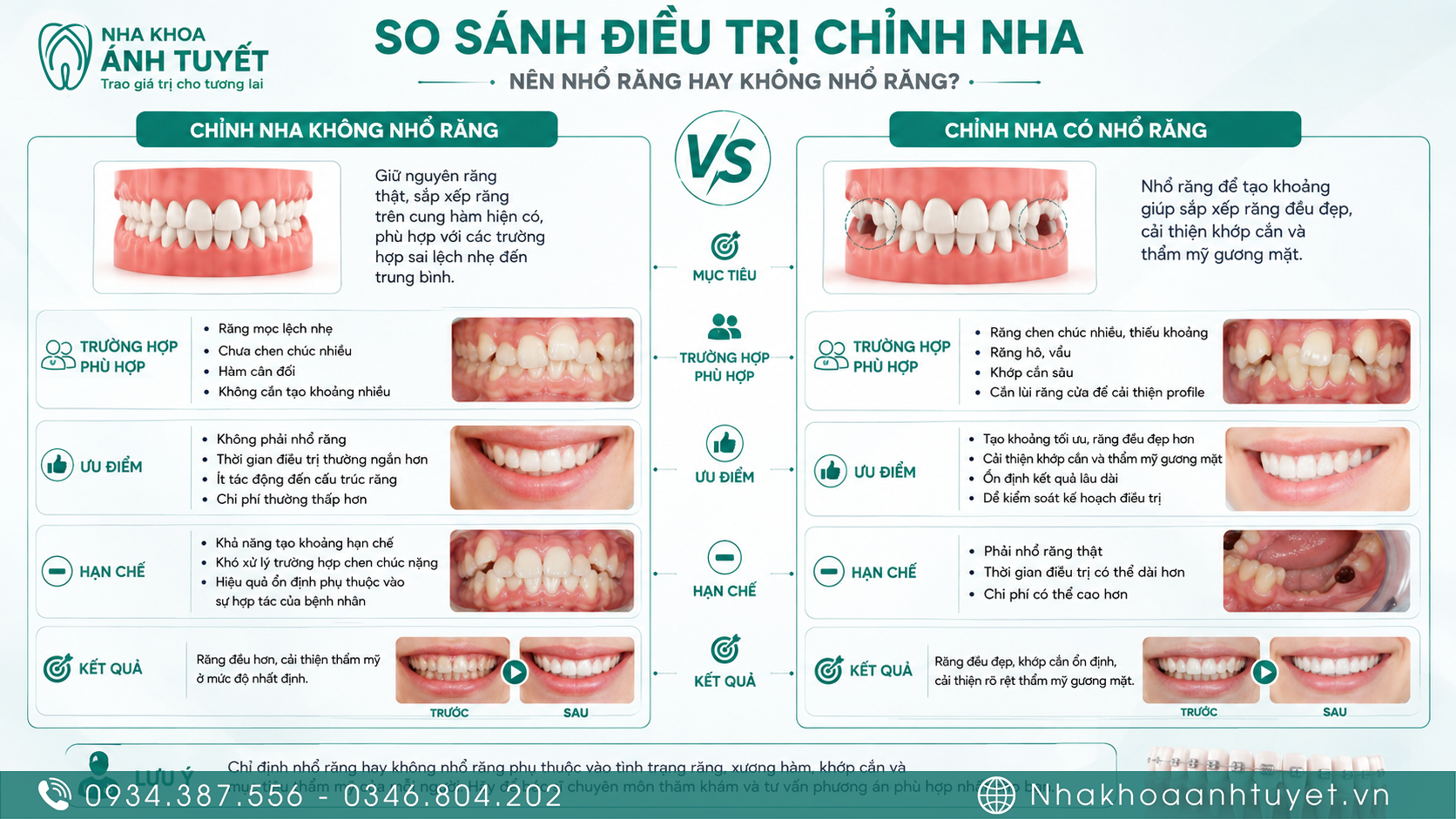 Bảng so sánh trường hợp niềng răng không nhổ răng và cần nhổ răng