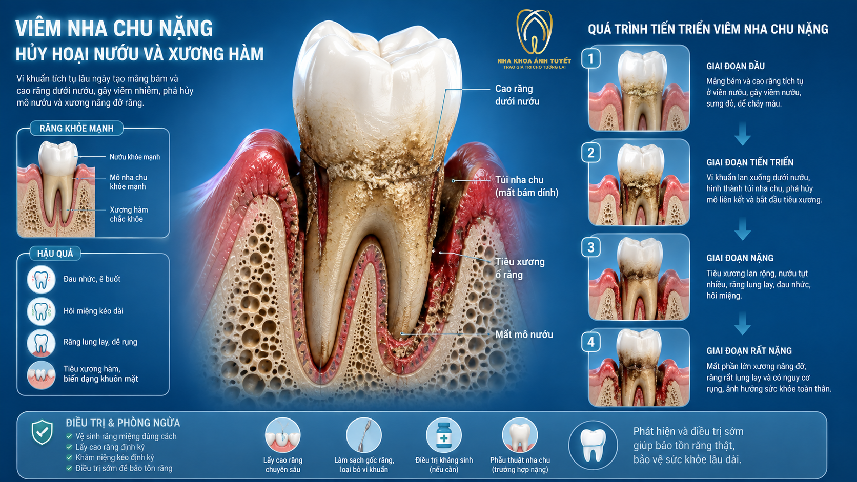 Mô phỏng 3D vi khuẩn viêm nha chu tàn phá cấu trúc dây chằng nha chu