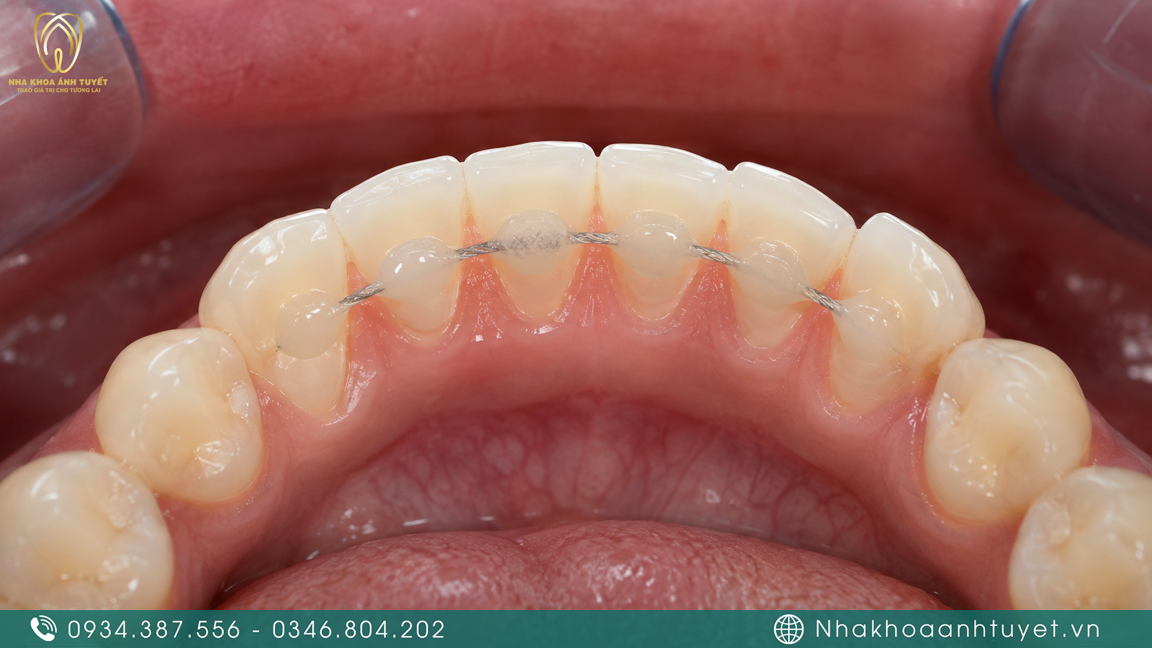 Kỹ thuật nẹp cố định giúp phục hồi liên kết chân răng chắc khỏe