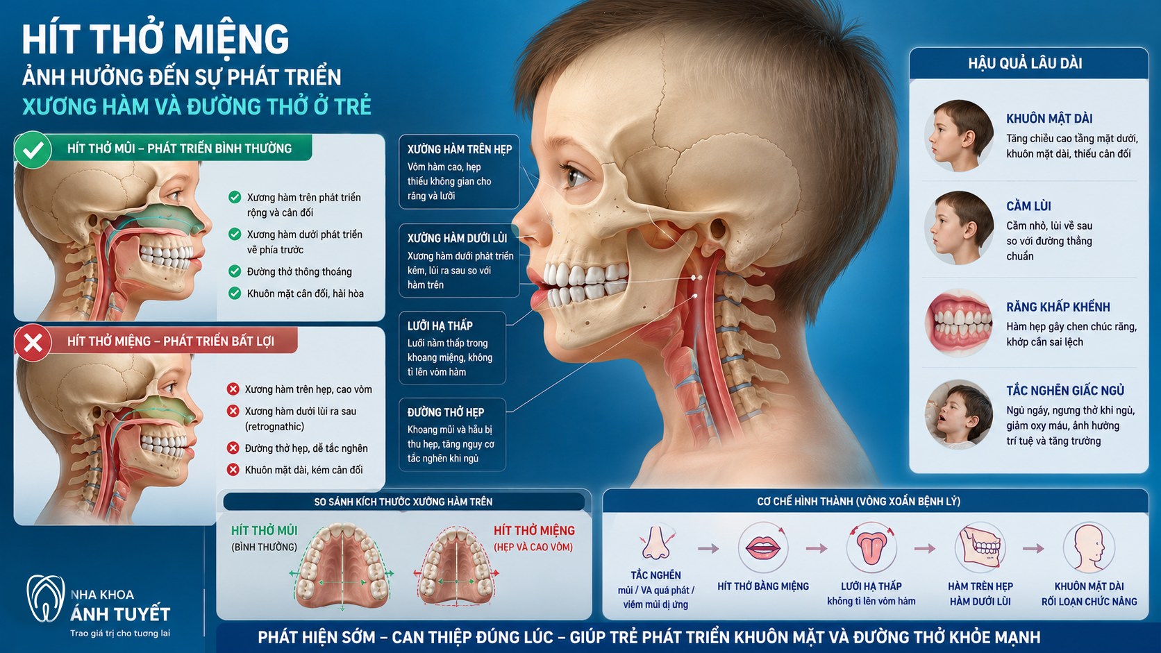 Mô phỏng 3D cấu trúc xương hàm bị hẹp và lùi cằm do thói quen thở bằng miệng