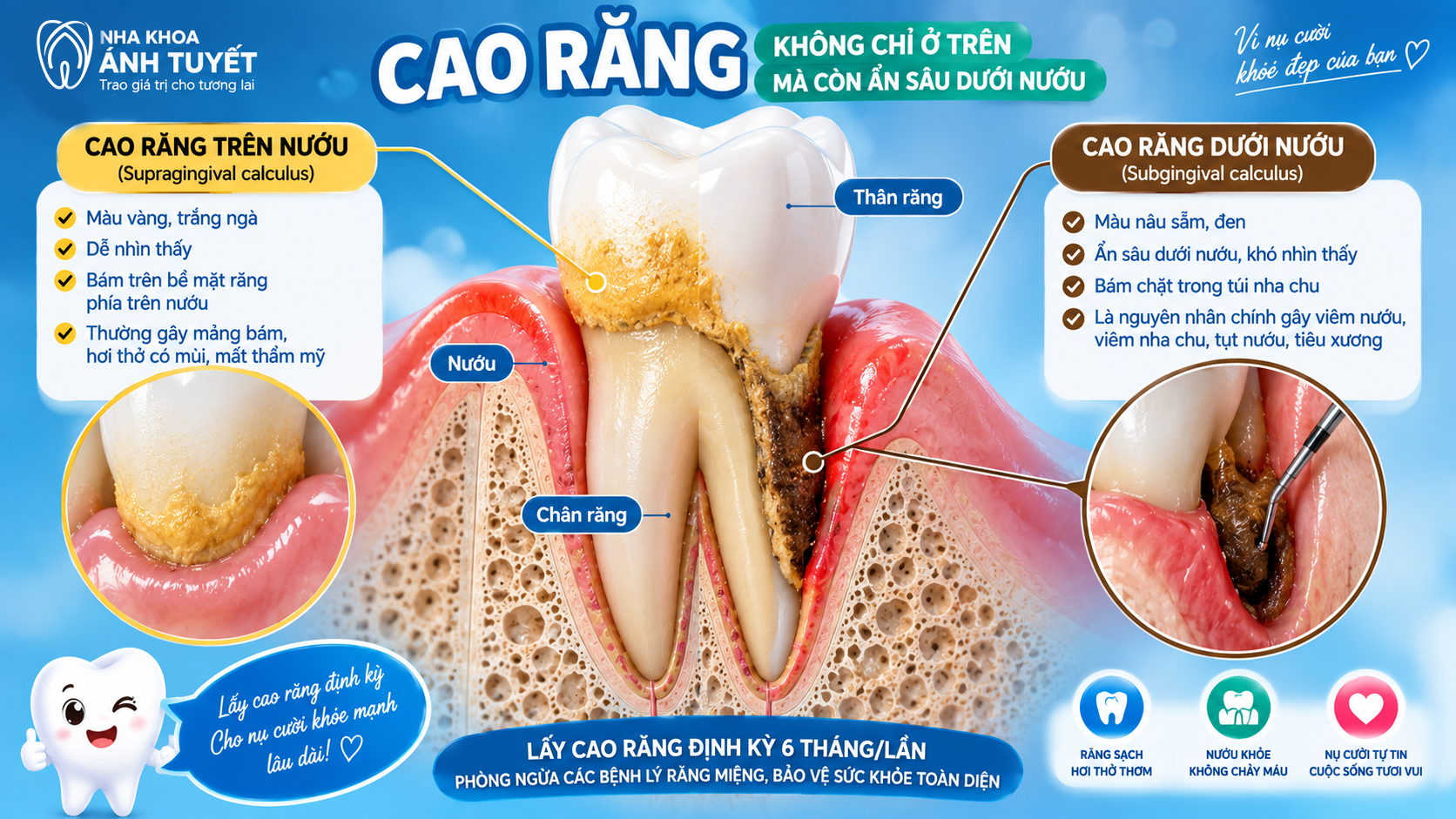 Mô phỏng 3D sự khác biệt giữa vôi trên nướu và vôi răng dưới nướu ẩn sâu trong túi nha chu