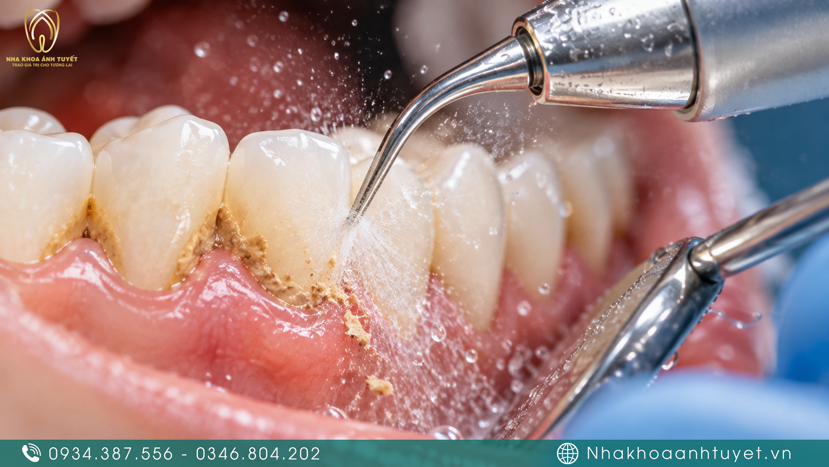 Đầu siêu âm chuyên dụng làm sạch vôi răng dưới nướu êm ái không làm tổn thương mô mềm