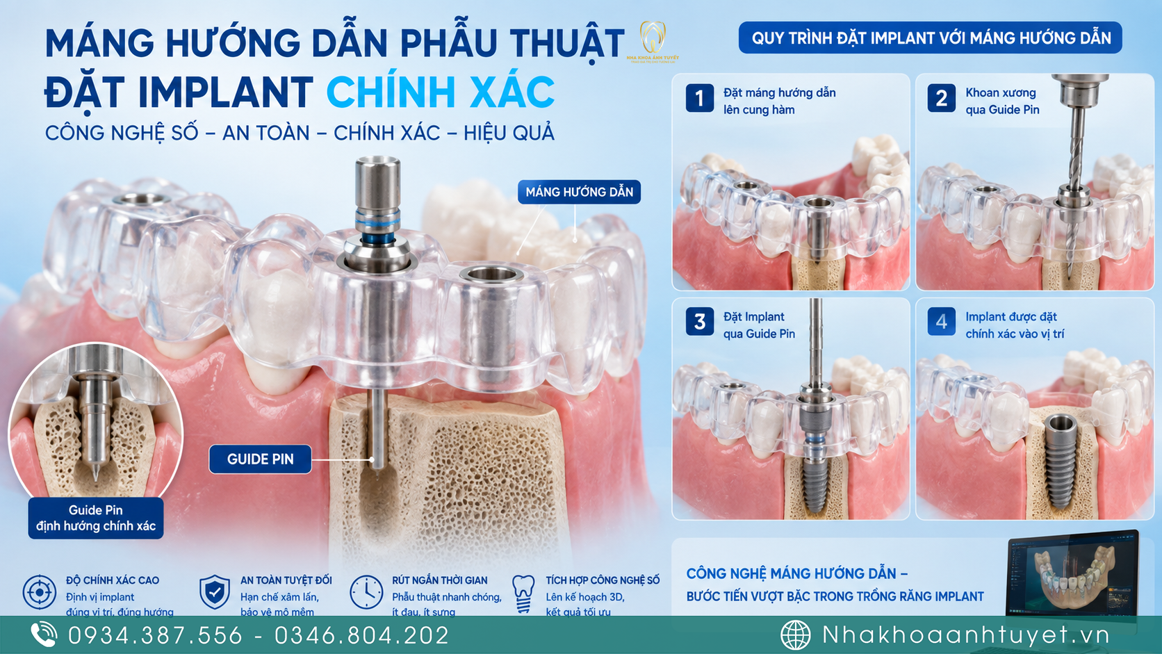Bác sĩ sử dụng máng hướng dẫn phẫu thuật số hóa cấy ghép Implant vi phẫu
