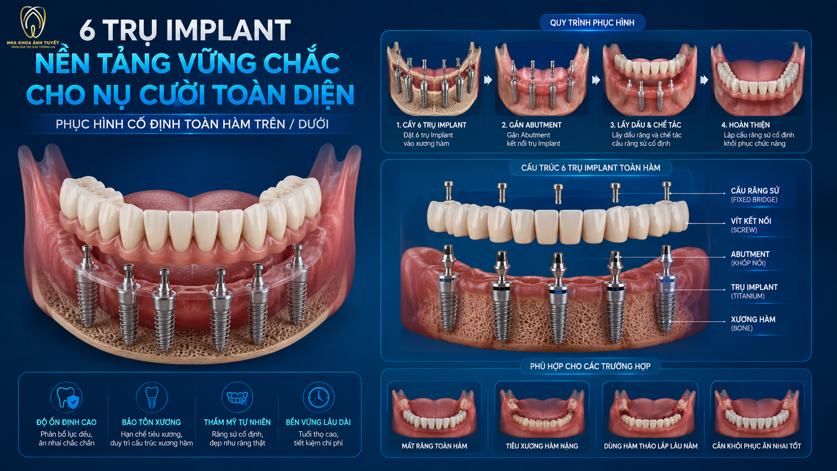 Sơ đồ 3D cấu trúc cấy ghép implant All on 6 nâng đỡ dãy răng