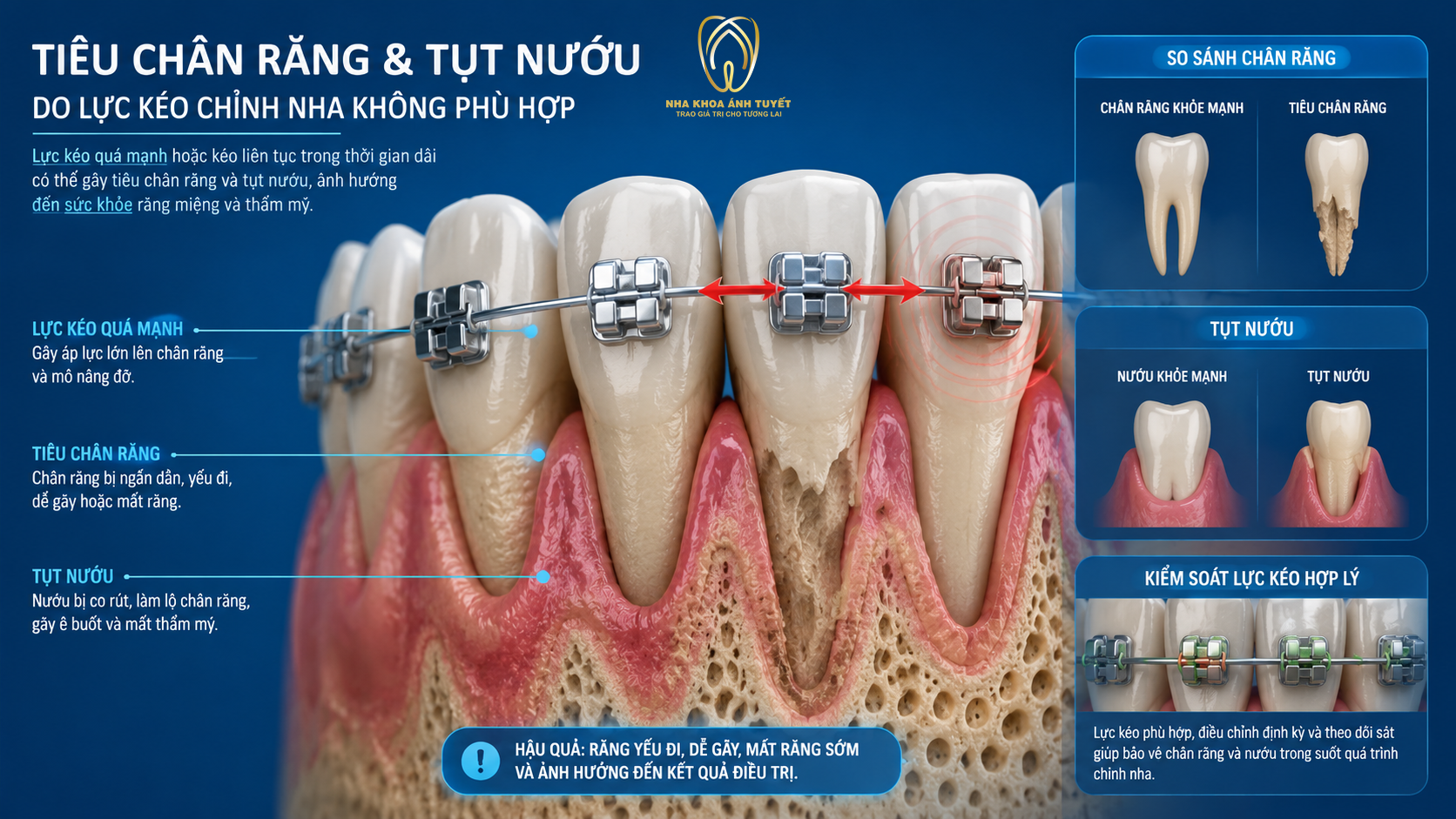 Mô phỏng 3D hiện tượng tiêu chân răng không hồi phục do lực kéo quá mạnh