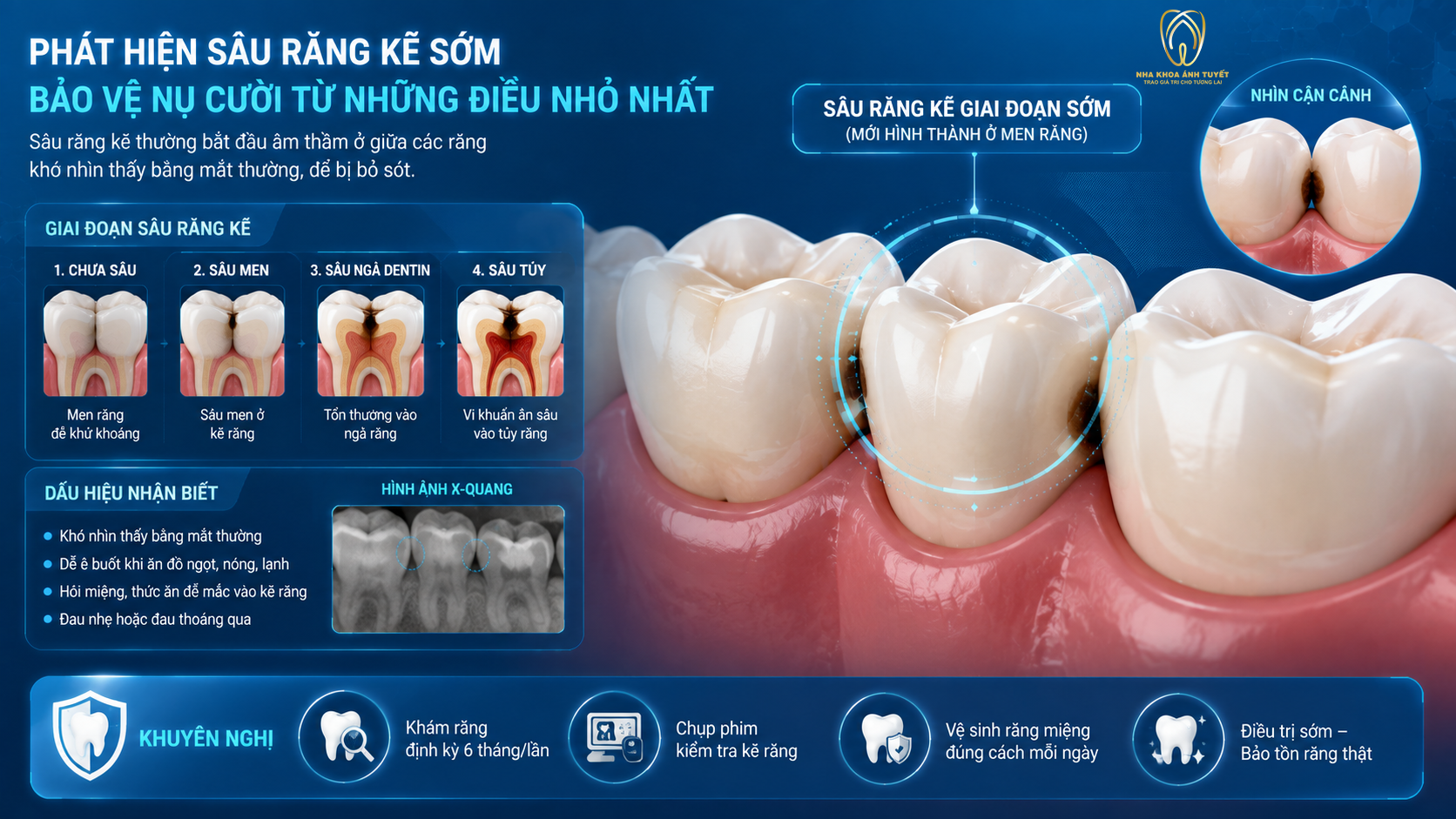Hình ảnh 3D mô phỏng vết sâu răng kẽ được phát hiện qua tầm soát bệnh lý răng miệng