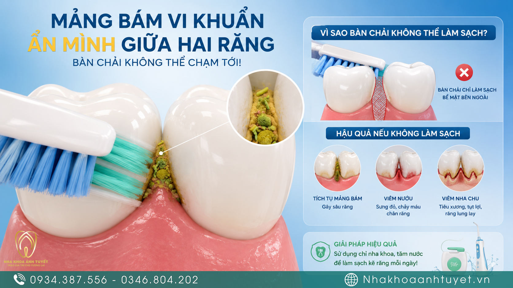 Hình ảnh mô phỏng mảng bám tích tụ ở kẽ răng mà bàn chải thông thường không chạm tới