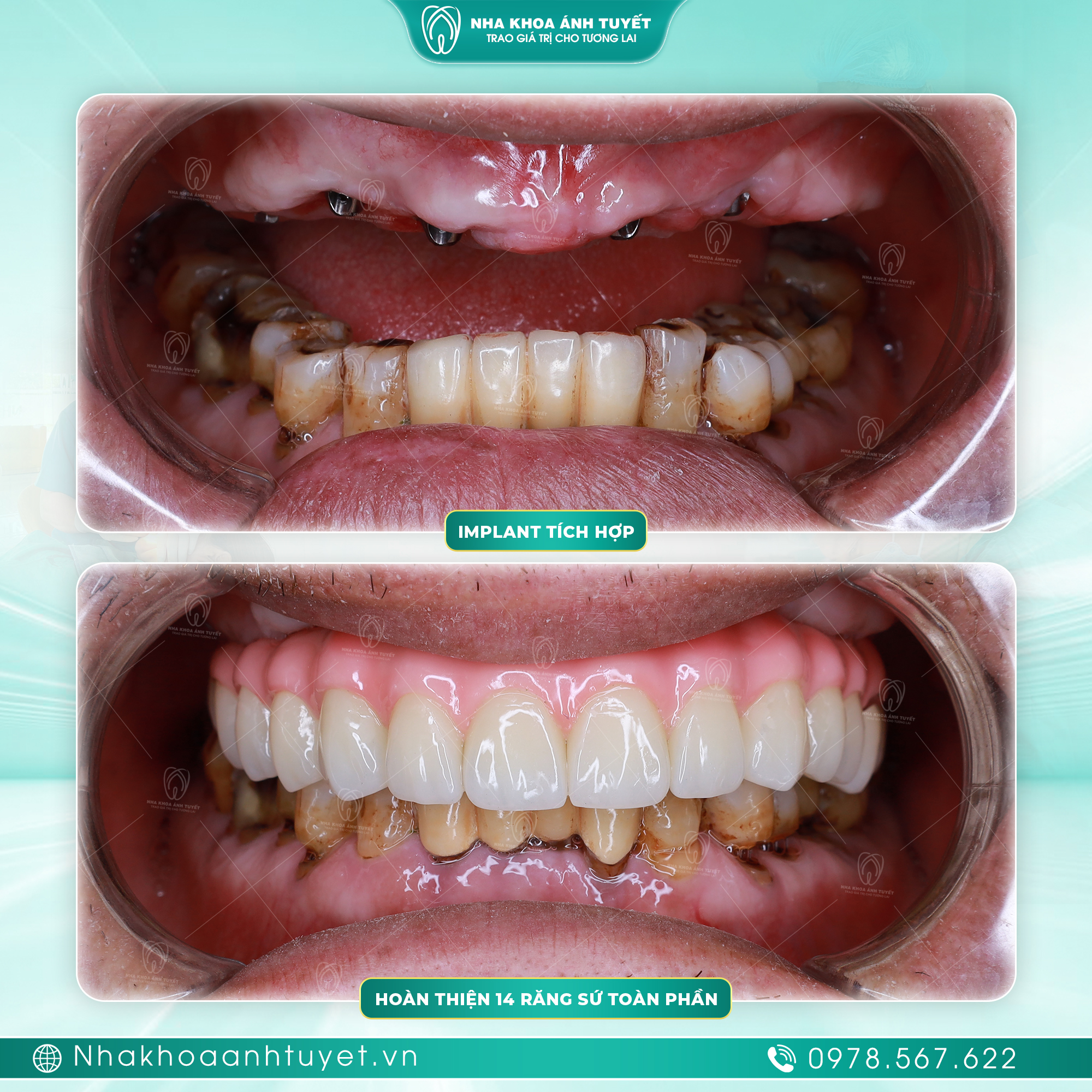 Trồng Răng Implant All-on-4 Tại Thái Thụy
