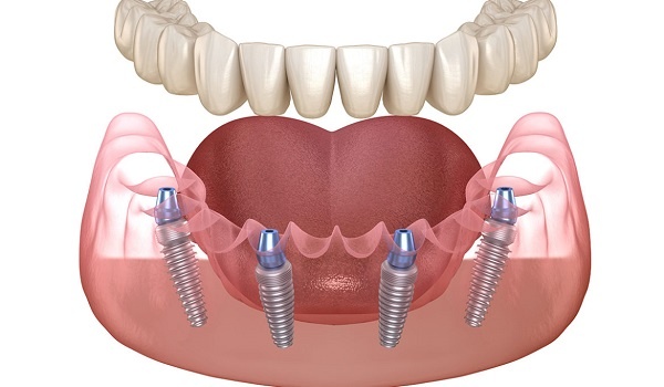 Implant All-on-4 là gì?